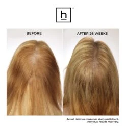 HairMax LaserBand 41 ComfortFlex Hair Growth Device 18 HairMax LaserBand 41 ComfortFlex Hair Growth Device -Bumble Sale Store 856823006510 7