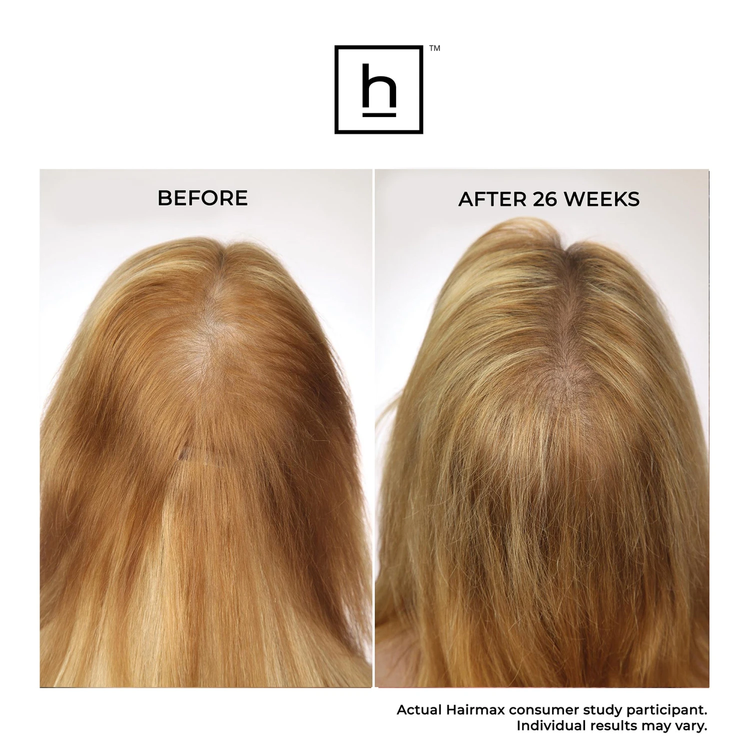 HairMax LaserBand 41 ComfortFlex Hair Growth Device 9 HairMax LaserBand 41 ComfortFlex Hair Growth Device - Image 7