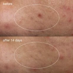 Dermalogica Deep Acne Liquid Patch -Bumble Sale Store Dermalogica Deep Acne Liquid Patch 2