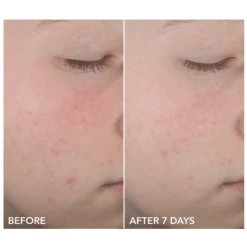 Dr Dennis Gross Dr. Dennis Gross Alpha Beta On The Spot Eliminator -Bumble Sale Store Dr.Dennis Gross Alpha Beta On The Spot Eliminator 7