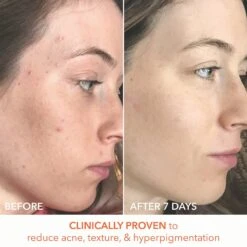 Dr Dennis Gross Dr. Dennis Gross Alpha Beta Universal Daily Peel 5 Pk 16 Dr Dennis Gross Dr. Dennis Gross Alpha Beta Universal Daily Peel 5 Pk -Bumble Sale Store Dr.Dennis Gross Alpha Beta Universal Daily Peel 5Pk 2