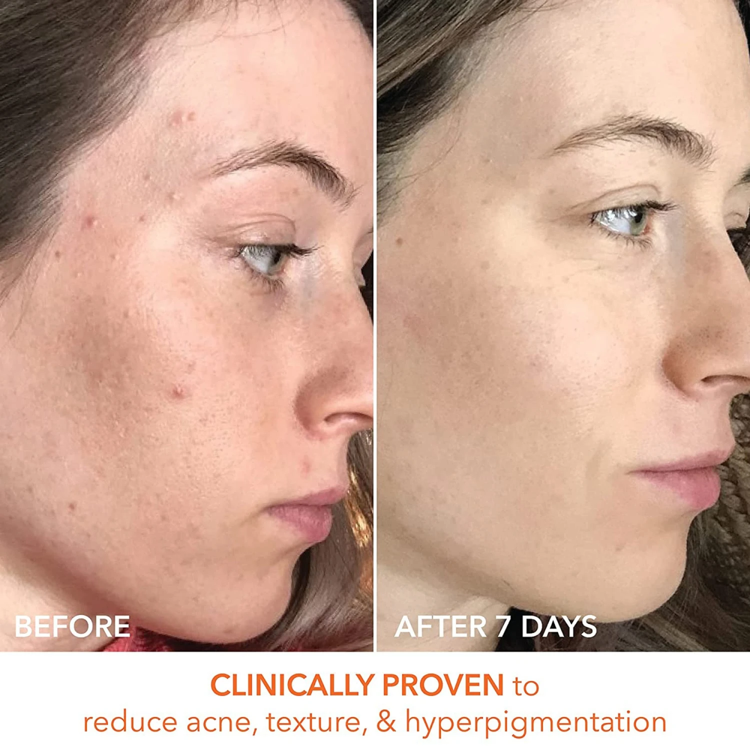 Dr Dennis Gross Dr. Dennis Gross Alpha Beta Universal Daily Peel 60 Pk 9 Dr Dennis Gross Dr. Dennis Gross Alpha Beta Universal Daily Peel 60 Pk - Image 7