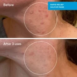 Murad Rapid Relief Acne Sulfur Mask -Bumble Sale Store Murad Rapid Relief Acne Sulfur Mask 2