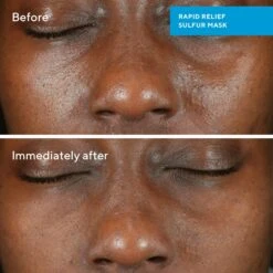 Murad Rapid Relief Acne Sulfur Mask -Bumble Sale Store Murad Rapid Relief Acne Sulfur Mask 3