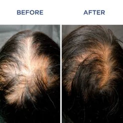 Phytocyane Women Treatment Progressive Hair Thinning -12 Vials -Bumble Sale Store Phyto PhytoCyane Women s Anti Hair Loss Progressive Treatment 3