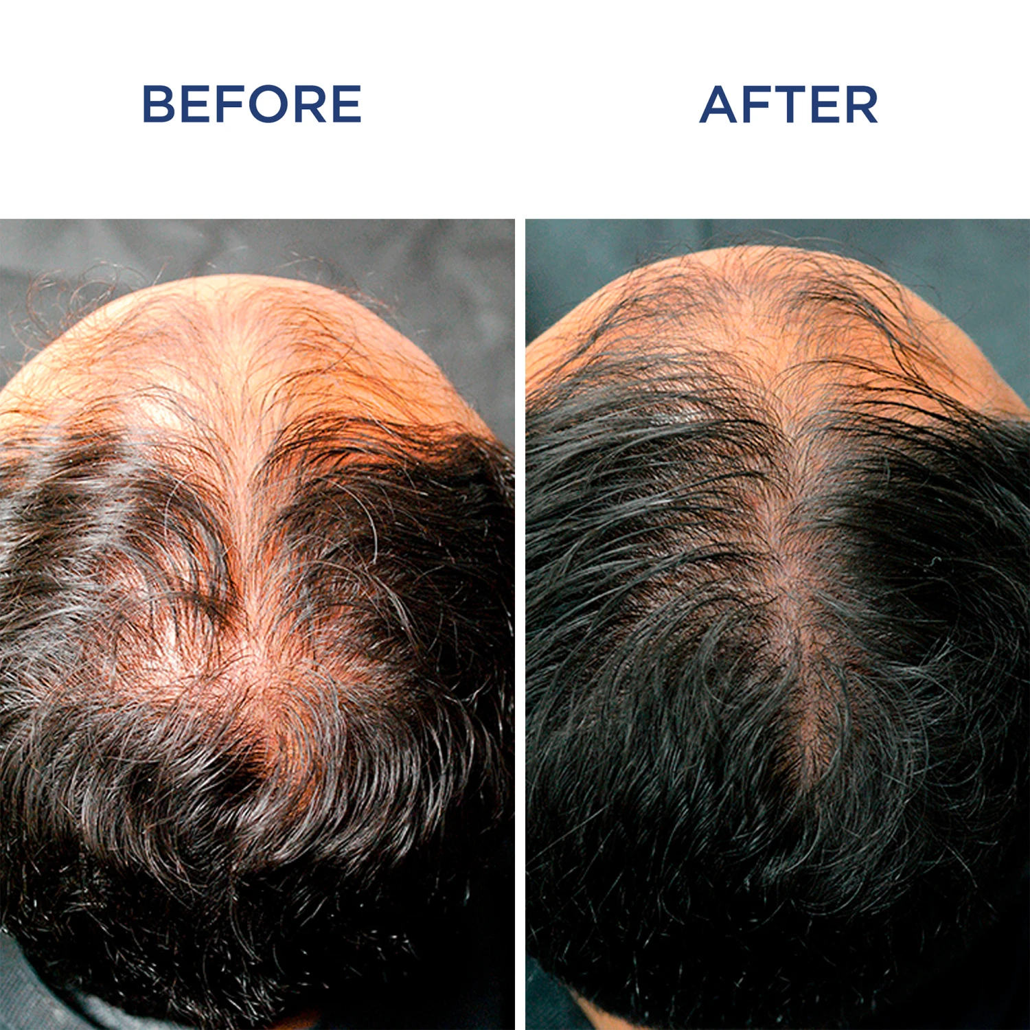 Phytocyane Men Treatment Progressive Hair Thinning - 12 Vials 8 Phytocyane Men Treatment Progressive Hair Thinning - 12 Vials - Image 6