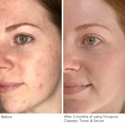 Caudalie Vinopure Serum -Bumble Sale Store caudalie vinopure serum 1oz3