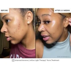 ReVive Lux SpotAcne Treatment Device 9 ReVive Lux SpotAcne Treatment Device -Bumble Sale Store reVive Lux Spot Acne e60661ba 4691 491c 837e c61264705be0